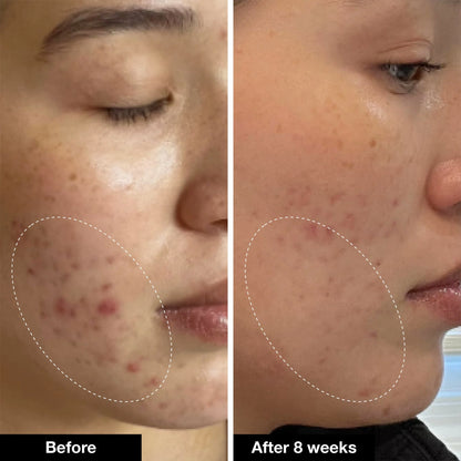 Hoygi Serum tegen Pigment