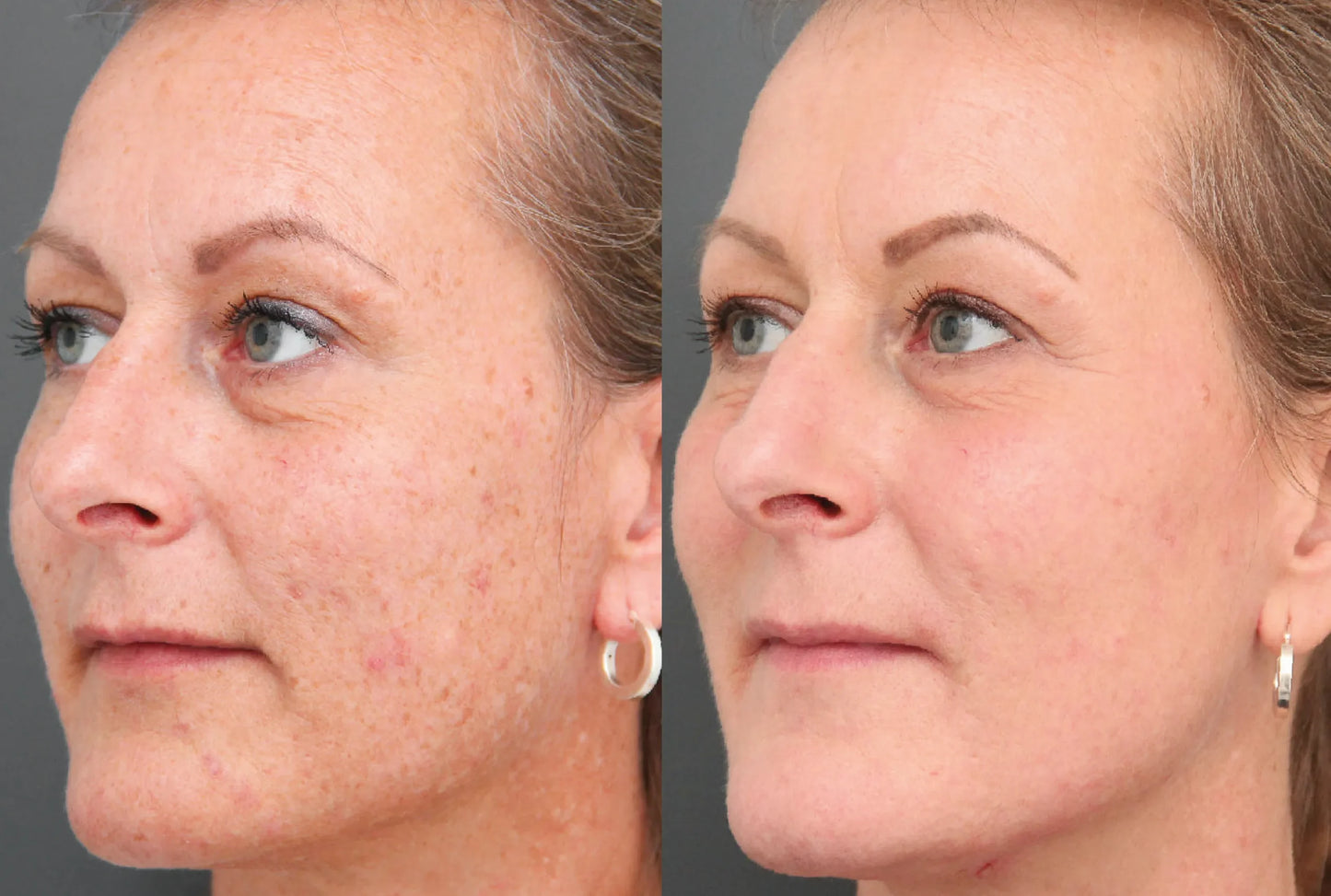 Hoygi Serum tegen Pigment