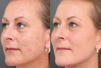 Hoygi Serum tegen Pigment