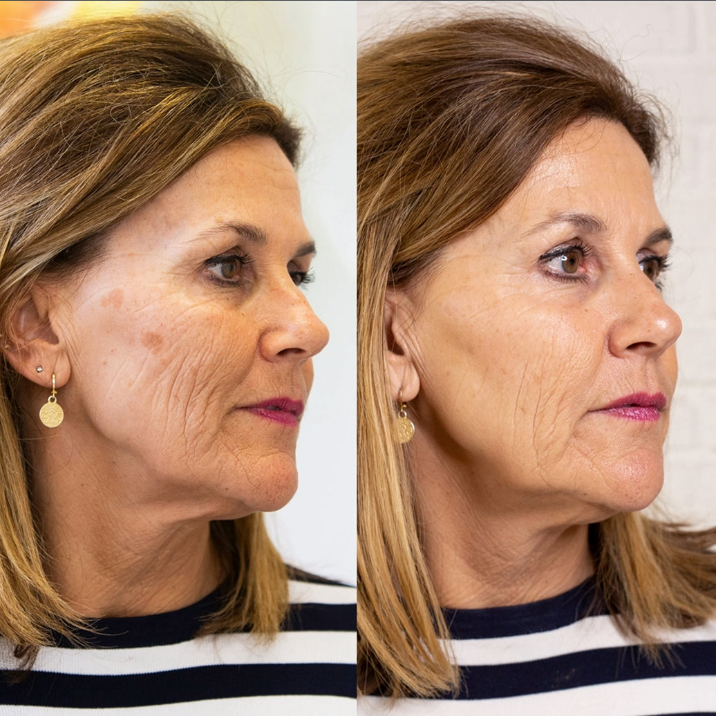 Hoygi Serum tegen Pigment