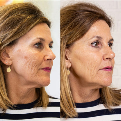 Hoygi Serum tegen Pigment