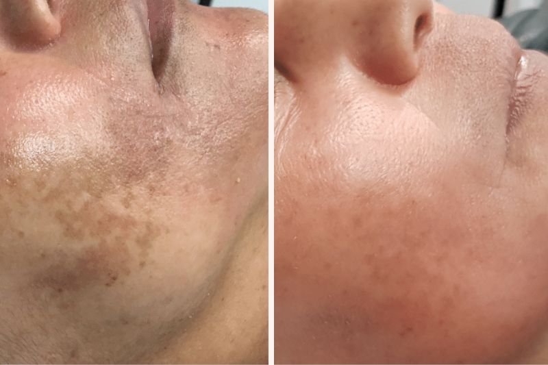 Hoygi Serum tegen Pigment