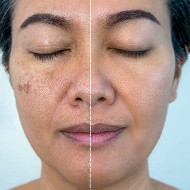 Hoygi Serum tegen Pigment